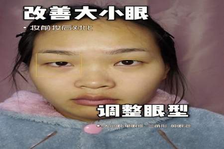 眼睛一只大一只小怎么快速解决