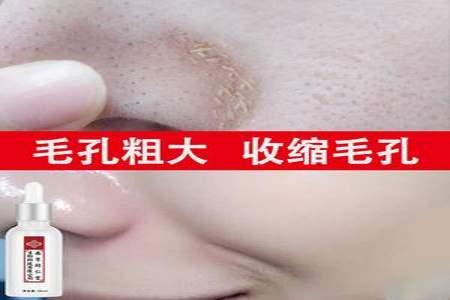 毛孔粗大粉刺闭口多用什么水乳